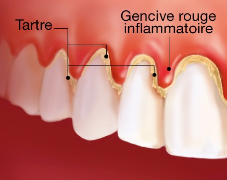 Gingivite